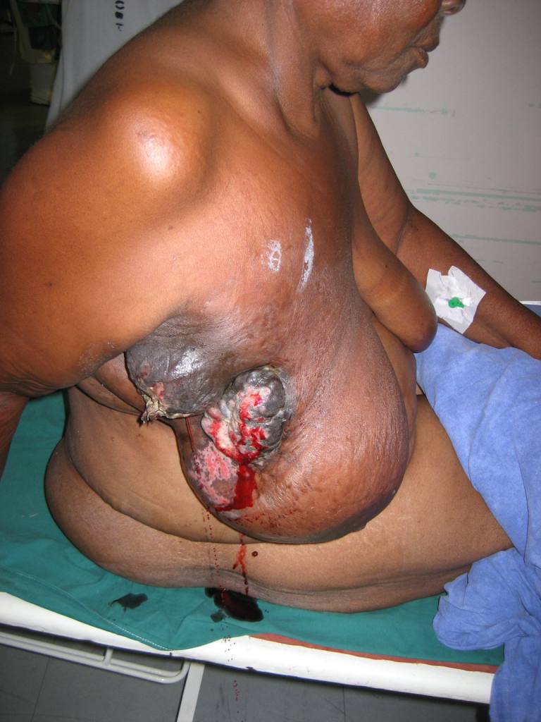 Breast-Cancer-Tumor-Zimbabwe